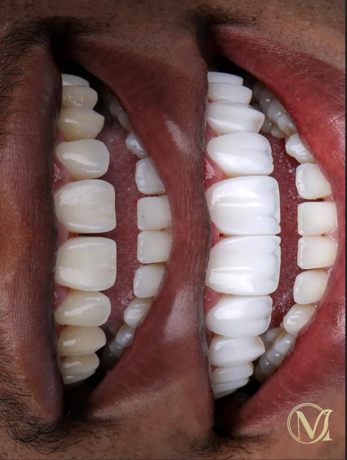 Resultado real: antes e depois lateral